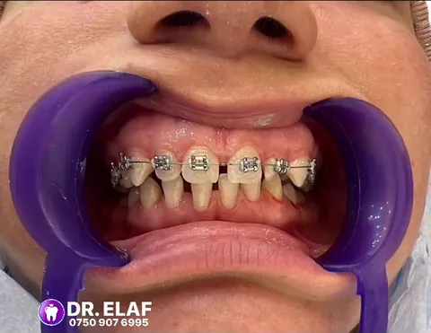 منظر أمامي للتقويم أثناء علاج تقويم الأسنان